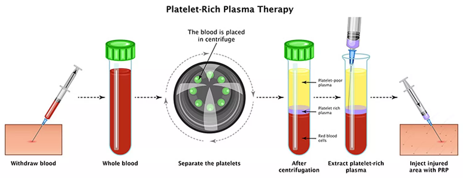 PRP Platelet-Rich Plasma Therapy In Jalandhar 