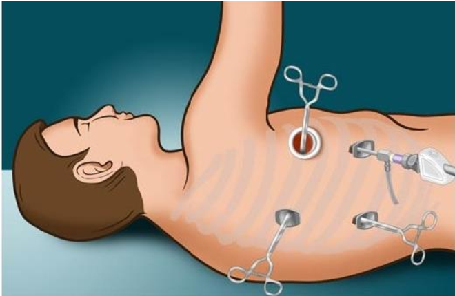 Thoracoscopic Surgery