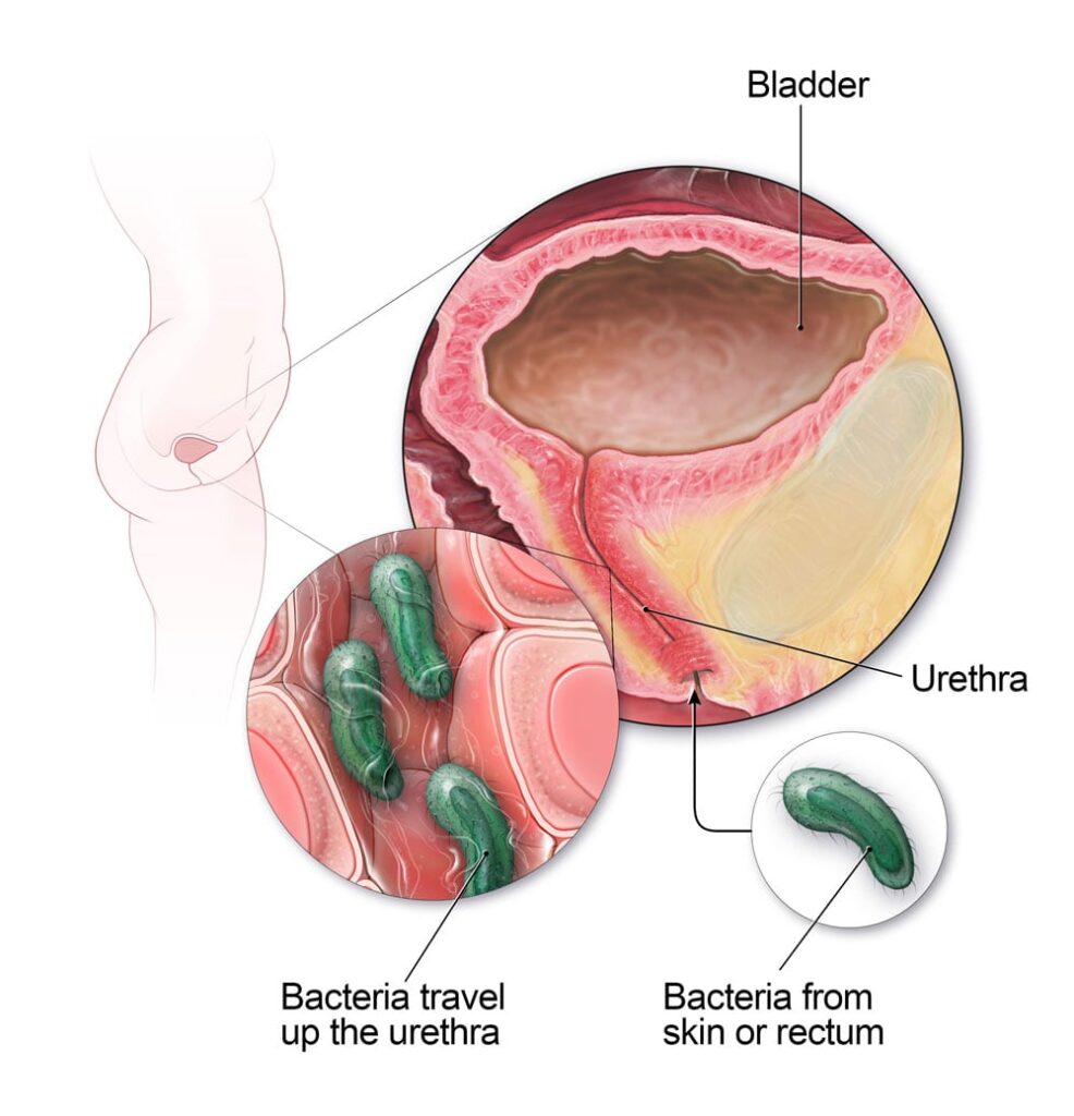 UTI Treatment in Jalandhar Punjab