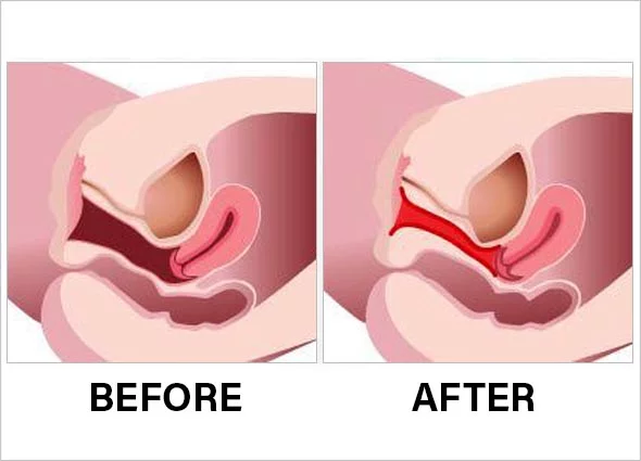 vaginal rejuvenation in jalandhar