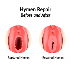 best hymenoplasty in punjab